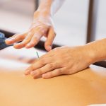 Therapist putting needles on back during acupuncture therapy session